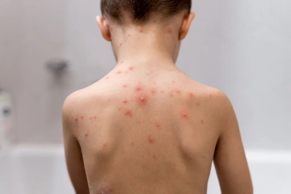 Is viral Rash contagious?